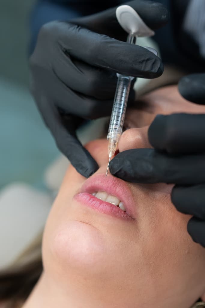 Dezente Lippenunterspritzung mit 0,5 bis 0,7 ml Hyaluron bei A&F Doctors