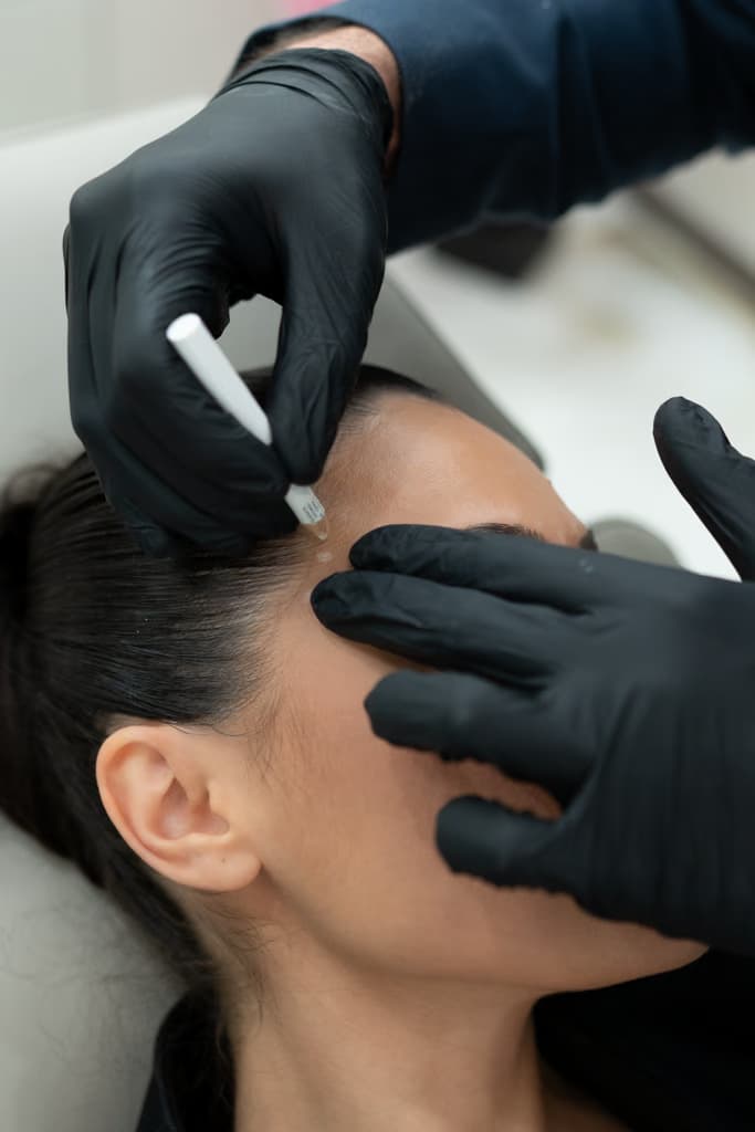 Migräne-Botox® Einzeichnen der Injektionspunkte